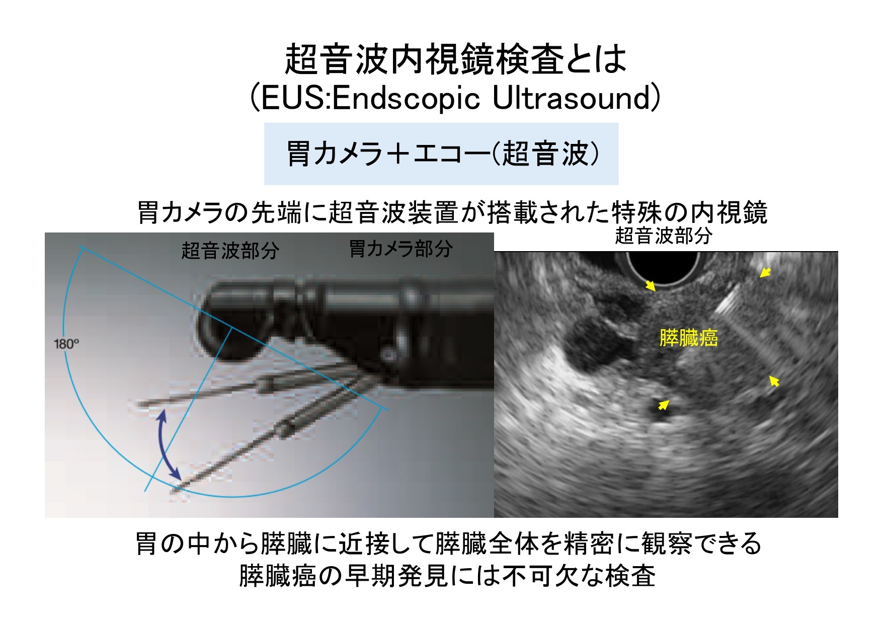 超音波内視鏡説明